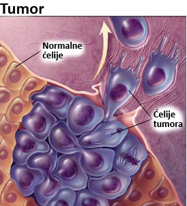 Tumor, rak, kancer, karcinom