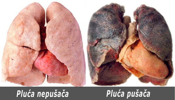 tumor pluća