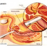 tumor, prostate