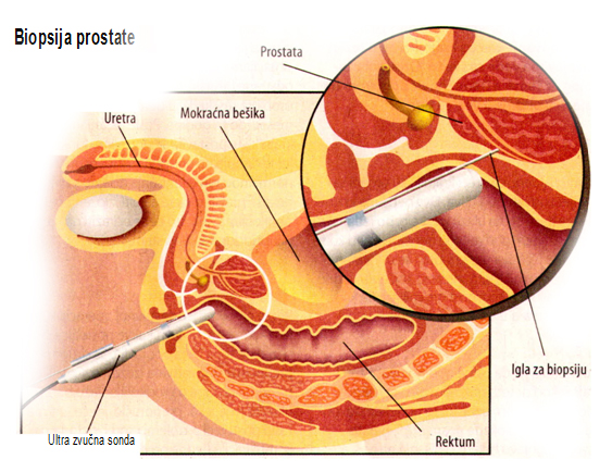 tumor, prostate