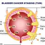 Tumor mokraćne bešike