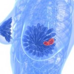 tumor dojke
