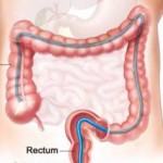 Debelo-crevo-colon-i-rectum